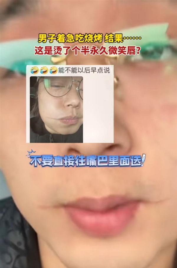 男子吃烧烤被烫出微笑唇：忽略了烤肉的铁签子温度高