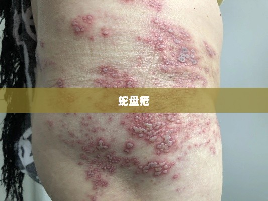 蛇盘疮，图片解析、识别方法及防治策略